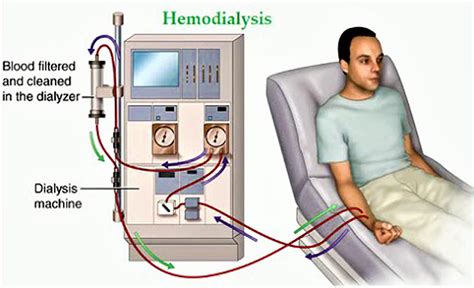 hemodialysis testing procedures